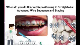 Staging and Timing for Bracket Repositioning