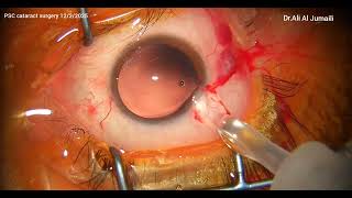 Posterior subcapsular cataract (PSC) phaco #cataractsurgery #cataract #eyecare #ophthalmology