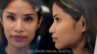 Revision Asian Rhinoplasty by Dr. Philip Solomon