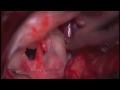 microsurgical resection of a left cerebellopontine angle epidermoid tumor