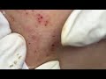 big cystic acne blackheads extraction blackheads u0026 milia whiteheads removal pimple popping