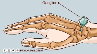 El bileğindeki ganglion kistleri | Prof. Dr. Yakup YILDIRIM