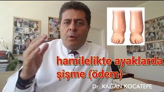 Hamilelikte ayaklarda şişme (ödem) için bitkisel ilaçlar ve tedavi çözümleri?