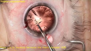 Evaluation of AI–Based Intraoperative Guidance Tools for Phacoemulsification Cataract Surgery