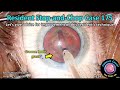 CataractCoach™ 2245: resident stop-and-chop cataract case 175