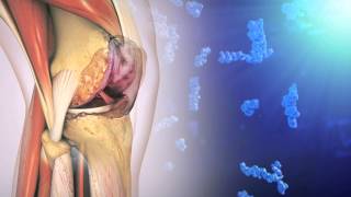 Hyaluronic Acid and Osteoarthritis of the Knee