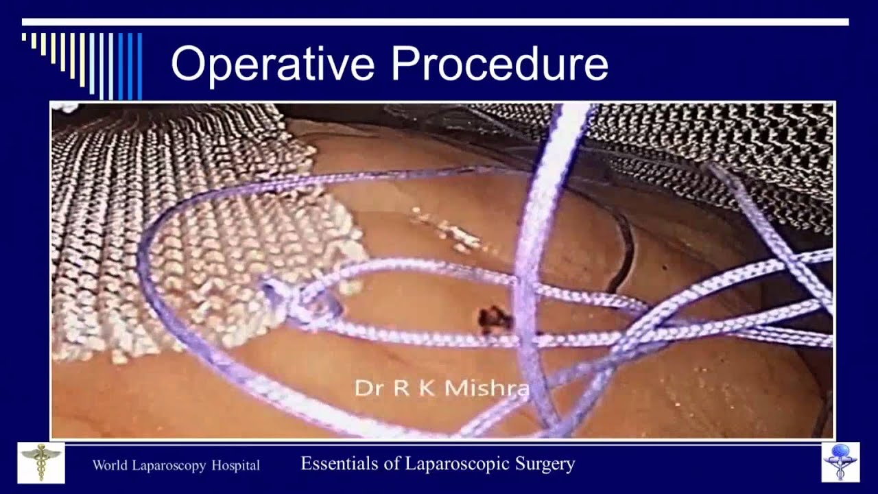 Master Class Of Laparoscopic Repair Of Ventral Hernia By Dr. R.K ...