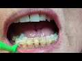 flossing and cleaning between teeth with braces retainers