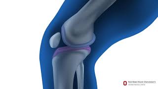 What is knee replacement surgery? | Ohio State Medical Center