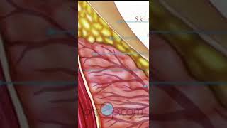 Understanding Breast Needle Biopsy 🎗️ What You Need to Know! #PreOp #Shorts PreOp® Patient Education