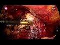 tapp for recurrent inguinal hernia watch till the end for tips