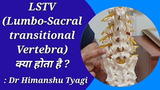 LSTV ( LUMBOSACRAL TRANSITIONAL VERTEBRA)  क्या होता है?