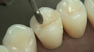 Class II Composite Preparation & Restoration | Operative Dentistry