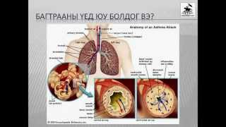 Астма = Гуурсан хоолойн багтраа өвчин