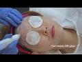 Popular blogger Elizabethheartz tries original Dermedics BB glow microneedling facial treatment