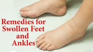 10 Natural Remedies For Swollen Feet And Ankles |  Ways to Reduce EDEMA Naturally at Home |