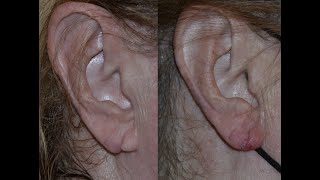 What to do when you have a torn earlobe?