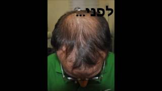 הדמיית שיער לגבר ת"א השתלת שיער לגברים תל אביב