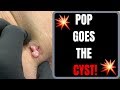 Pop Goes The Cyst!