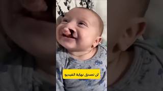 سبحان الله طفل خلق بدون شفه شاهد فى النهاية 😱