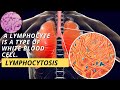 Lymphocytosis: Definition, Causes, Symptoms & Treatment