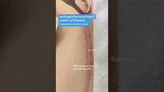 รักษาแผลเป็นนูนคีลอยด์จากผ่าตัดคลอด Cesarean section scar treatment Picosecond Laser l หมอรุจชวนคุย