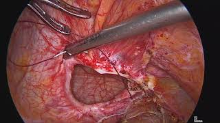 Large Bowel Obstruction due to incarcerated Spigelian hernia: a video vignette of lap mesh repair