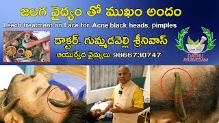 జలగ వైద్యం తో ముఖం అందం Leech treatment on Face for Acne,black heads, pimples DathuAyurvedam