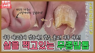 (ENG SUB)무좀때문에 발톱이 살을찍고있다! 너무아파 참을수없는 내성발톱! tinea unguium / athlete's foot - Fresh Foot 성수점 / 남양주호평점