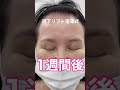 50代の眉下リフト、1週間後はどうなった⁉︎