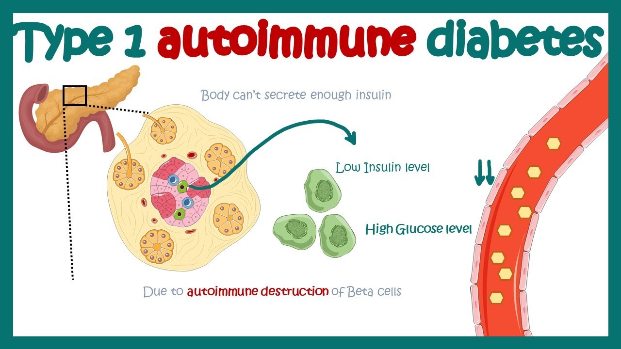 Type 1 Diabetes Autoimmune Diabetes Cause And Consequences Diabetes