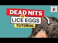 Dead Nits vs Live Lice Eggs Video Tutorial