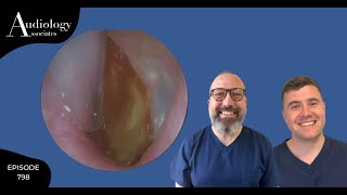 EPIC EAR WAX PEEL FROM EARDRUM - EP 798