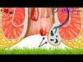 Saúde -  6 opções de Tratamentos para Hemorroidas Externas