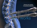 3d medical animation medtronics sextant fixation system of l4 l5 spine