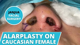 ALAR BASE REDUCTION (ALARPLASTY) ON CAUCASIAN FEMALE - DR. TANVEER JANJUA - NEW JERSEY