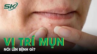 “Bắt Bệnh” Từ Vị Trí Mọc Mụn |SKĐS