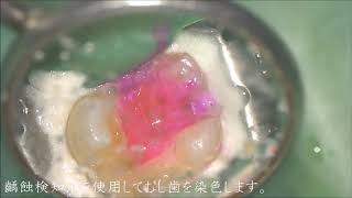 神経が死んでいる 歯ぐきが腫れている 寝ている時に痛い 熱いものがしみる 根管治療根っこ神経の治療　都内港区内幸町新橋虎ノ門日比谷霞ヶ関歯科歯医者日比谷千代田区　マイクロスコープラバーダムＣＴ