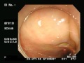 colonoscopy　typeb no.50　大腸内視鏡検査