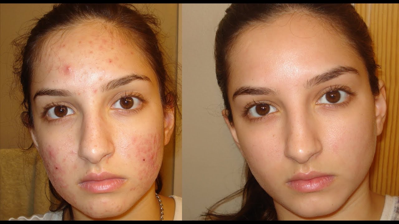 A True Miracle- How I Got Rid Of My Acne. Daily Skin-care Routine ...