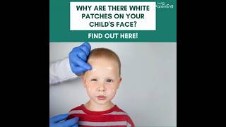 What Causes White Patches Or Spots ON Child's Face - Find Out Now!