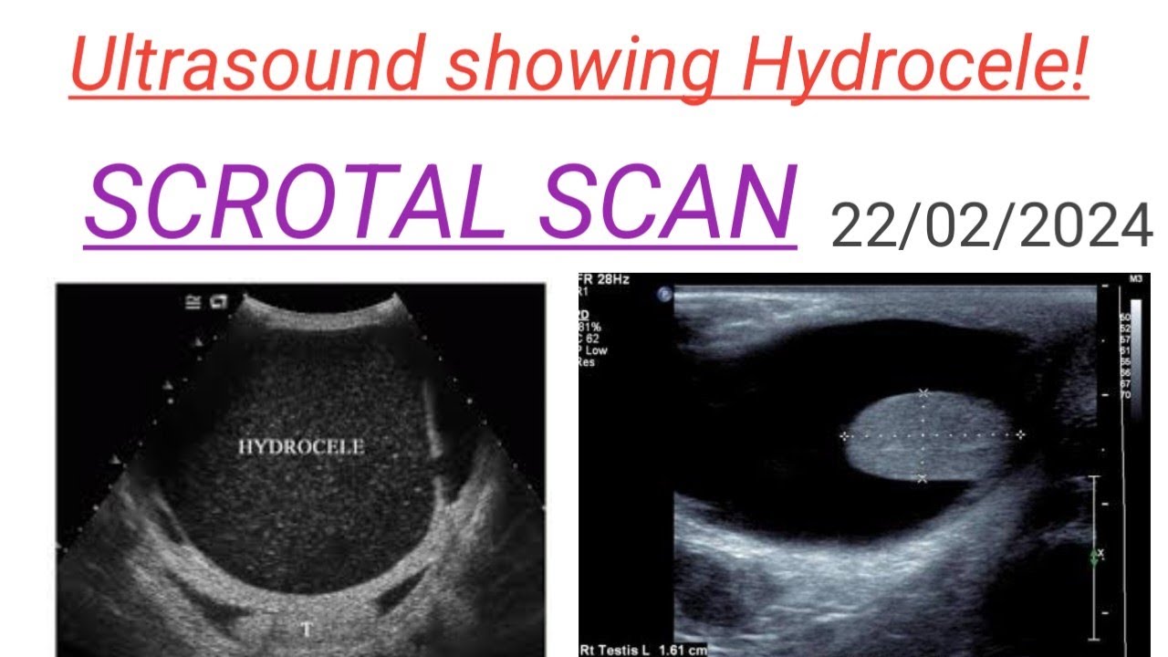 Ultrasound Showing Hydrocele!Scrotal Scan!#123ultrasonography#youtube# ...