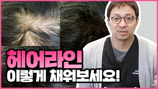 헤어라인 반영구 하면 티 안날까? (티나지 않고 효과 오래 유지하는 법)