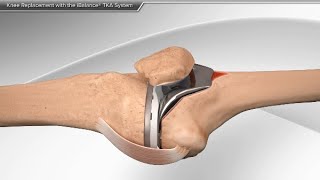 Knee Replacement with the iBalance TKA System