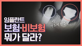 [무전치식] 임플란트 보험·비보험이 다르다고..? | 경산 호치과