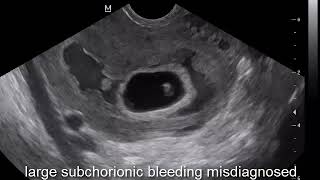 case 433 large subchorionic bleeding misdiagnosed as  partial molar pregnancy pseudopartial mole