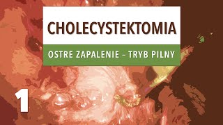 Cholecystektomia w ostrym zapaleniu pęcherzyka żółciowego #1