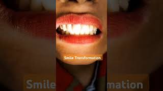 Smile transformationfix teeth bridge #dentalcare#dentist#dentalclinic#teeth #dentistry#dentalhealth