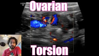 Ovarian Torsion