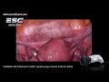 esc medicams full hd laparoscopic endoscopy camera 1080p 2.4mp fhd lp 4000r demo video